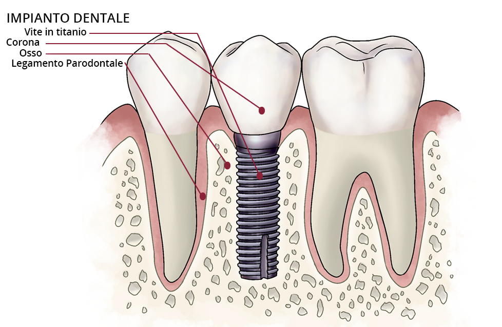 Implantologia dentale: la protesi come soluzione per più casi