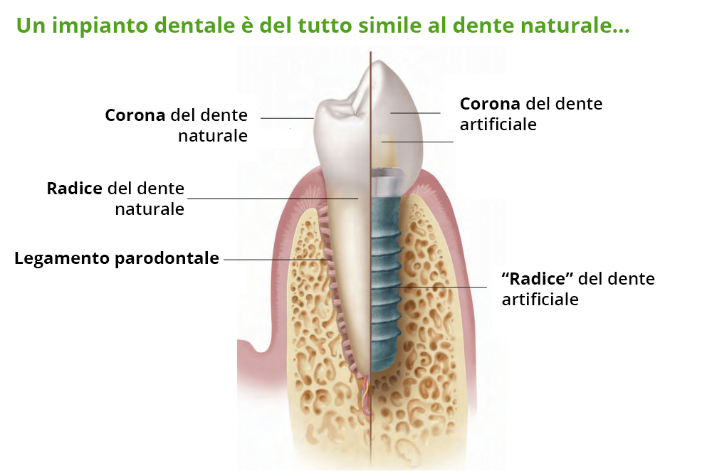 Implantologia dentale: la protesi come soluzione per più casi